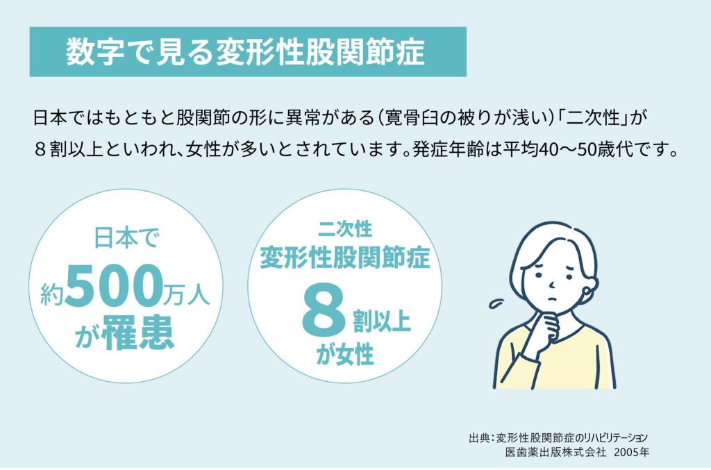 今月のテーマは 股関節 発症年齢は平均40 50歳代 特に女性に多い変形性股関節症 With Magazine Ja愛知厚生連