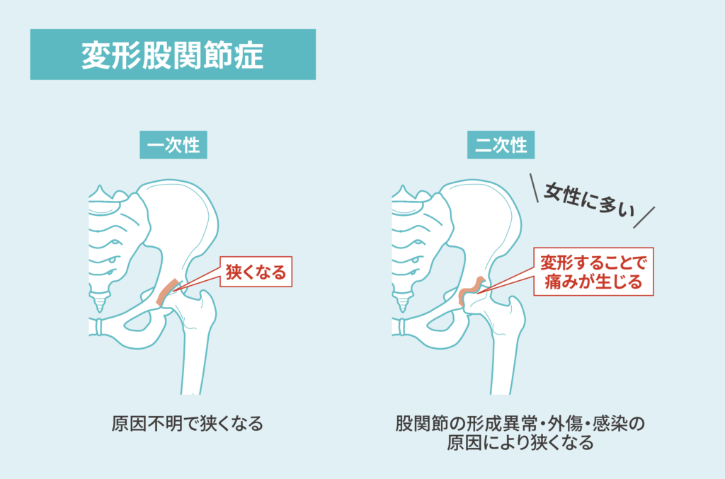 内側区画変形性関節症の原因と危険因子は何ですか?