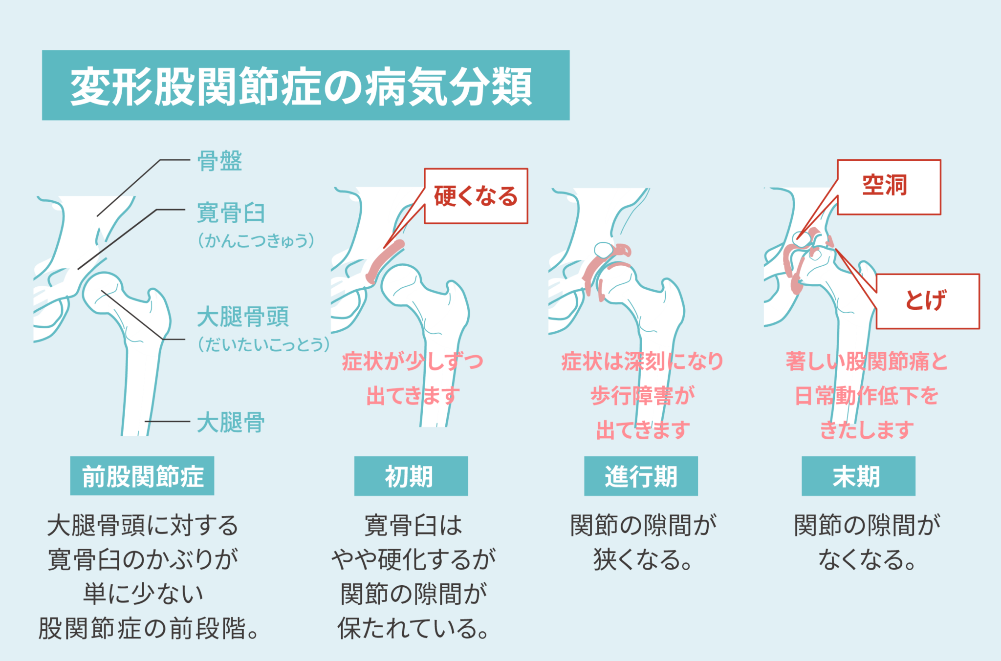 今月のテーマは「股関節」 発症年齢は平均40~50歳代 特に女性に多い変形性股関節症 | With Magazine | JA愛知厚生連