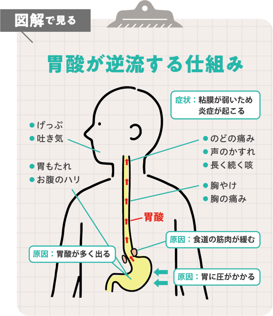 逆流 性 食道 炎 症状